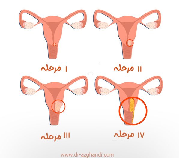 سرطان رحم و دهانه رحم + دکتر سمیرا ازقندی