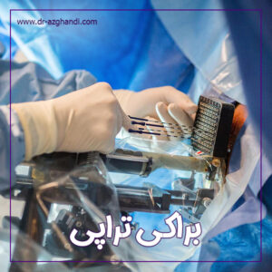 براکی ‌تراپی + دکتر سمیرا ازقندی