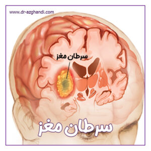 سرطان مغز + دکتر سمیرا ازقندی