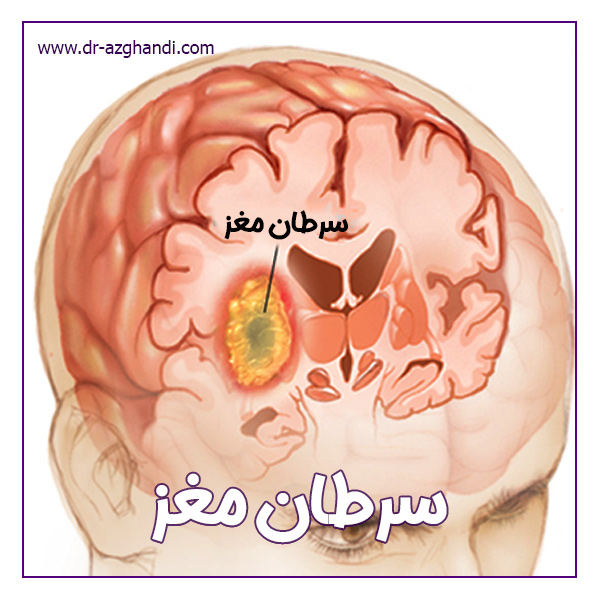 سرطان مغز + دکتر سمیرا ازقندی