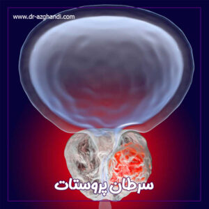 سرطان پروستات + دکتر سمیرا ازقندی