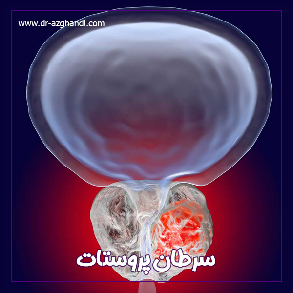 سرطان پروستات + دکتر سمیرا ازقندی