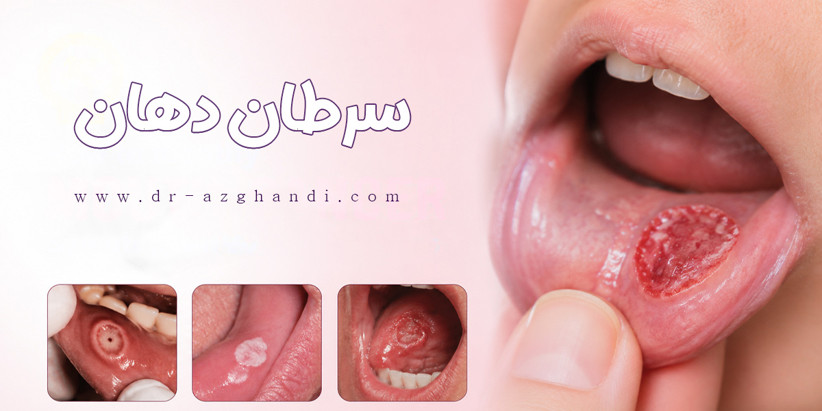 سرطان دهان + دکتر سمیرا ازقندی