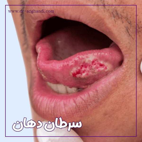 سرطان دهان + دکتر سمیرا ازقندی