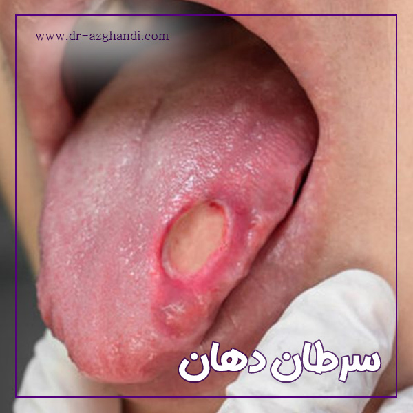 سرطان دهان + دکتر سمیرا ازقندی
