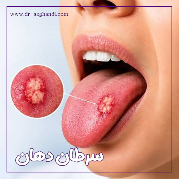 سرطان دهان + دکتر سمیرا ازقندی