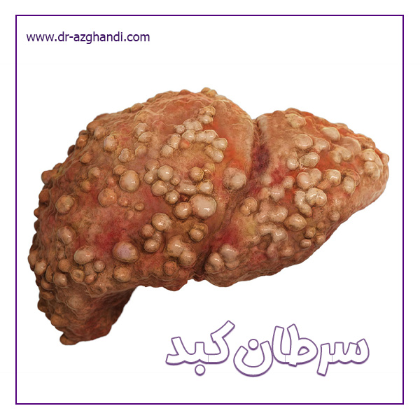 سرطان کبد + دکتر سمیرا ازقندی