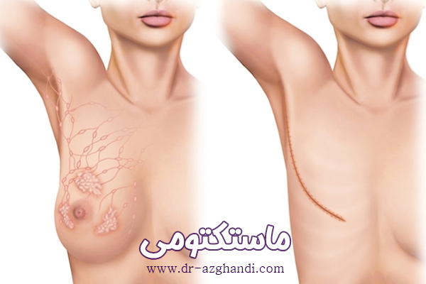 عمل تخلیه سینه یا عمل ماستکتومی چیست؟ 3 mastectomy 3 ماستکتومی + دکتر سمیرا ازقندی