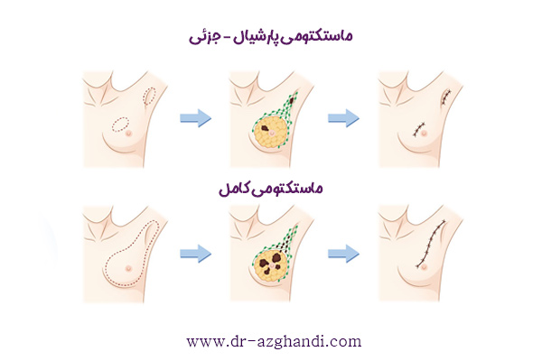 عمل تخلیه سینه یا عمل ماستکتومی چیست؟ 4 mastectomy 4 ماستکتومی + دکتر سمیرا ازقندی