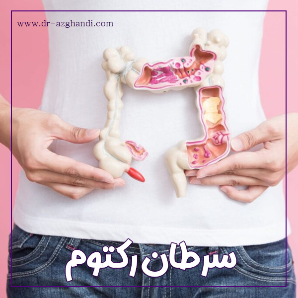 سرطان رکتوم + دکتر سمیرا ازقندی