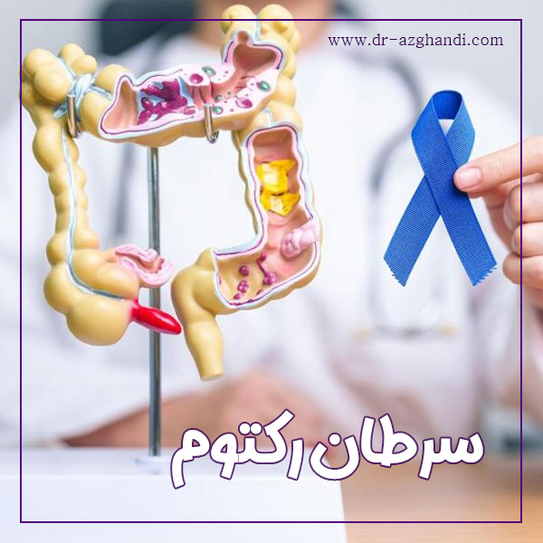 سرطان رکتوم + دکتر سمیرا ازقندی
