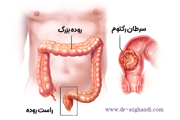 سرطان رکتوم + دکتر سمیرا ازقندی