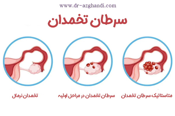 سرطان تخمدان + دکتر سمیرا ازقندی