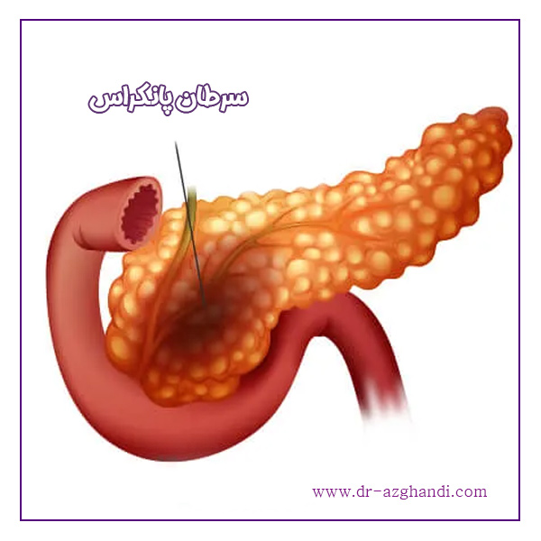 سرطان پانکراس + دکتر سمیرا ازقندی