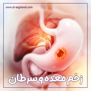 زخم معده و سرطان + دکتر سمیرا ازقندی