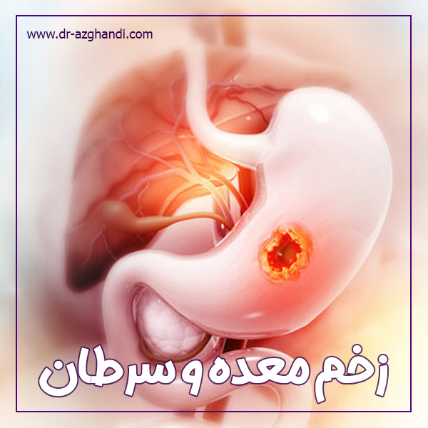 آیا زخم معده خطر ابتلا به سرطان را افزایش می دهد؟ 1 stomach ulcer and cancer 3 زخم معده و سرطان + دکتر سمیرا ازقندی