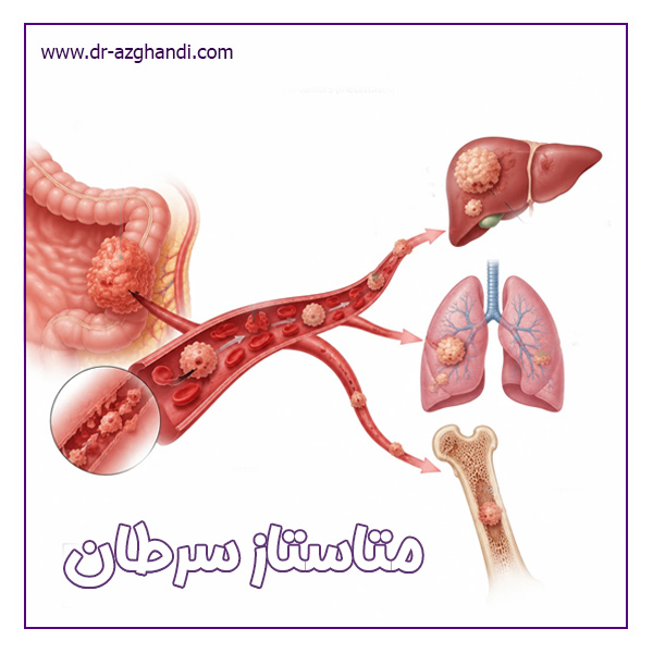 متاستاز سرطان ؛ همه چیز درباره گسترش سرطان در بدن 1 cancer metastasis 6 متاستاز سرطان + دکتر سمیرا ازقندی