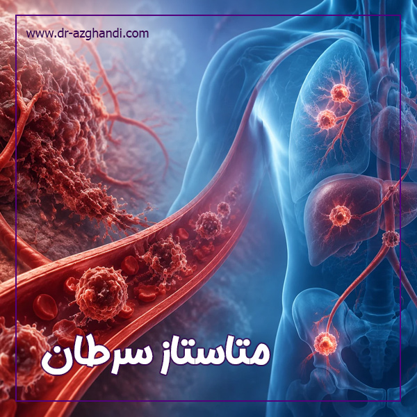 متاستاز سرطان ؛ همه چیز درباره گسترش سرطان در بدن 4 cancer metastasis 7 متاستاز سرطان + دکتر سمیرا ازقندی