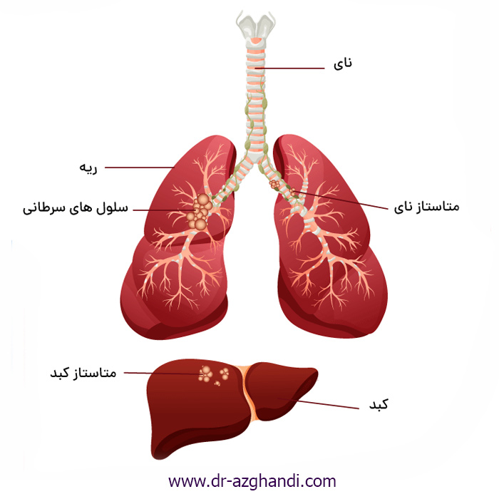 متاستاز سرطان ؛ همه چیز درباره گسترش سرطان در بدن 2 cancer metastasis 8 متاستاز سرطان + دکتر سمیرا ازقندی