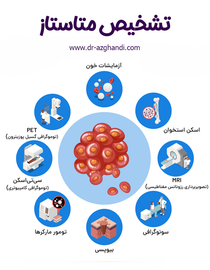 متاستاز سرطان ؛ همه چیز درباره گسترش سرطان در بدن 3 cancer metastasis 9 متاستاز سرطان + دکتر سمیرا ازقندی