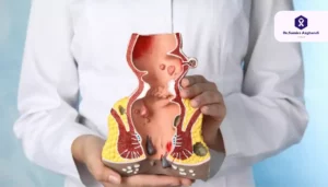 بواسیر و سرطان روده