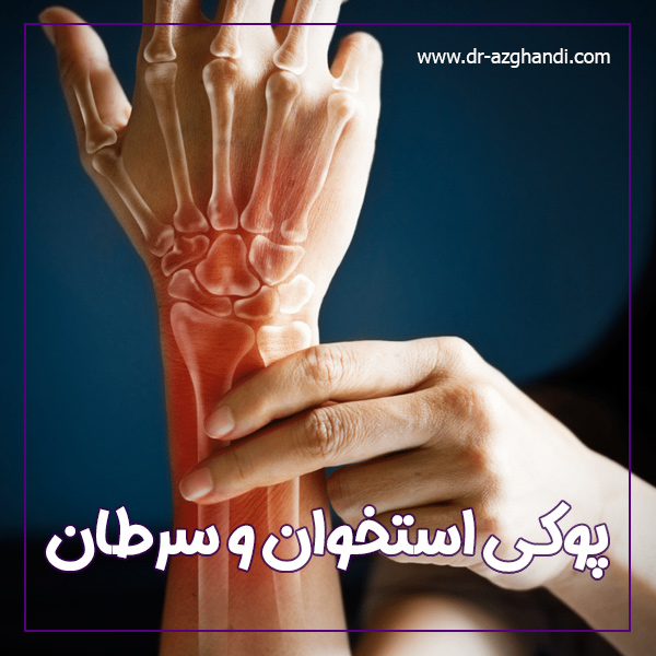 پوکی استخوان و سرطان + دکتر سمیرا ازقندی