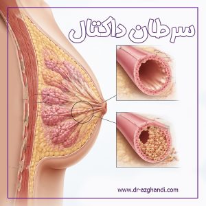 سرطان داکتال + دکتر سمیرا ازقندی