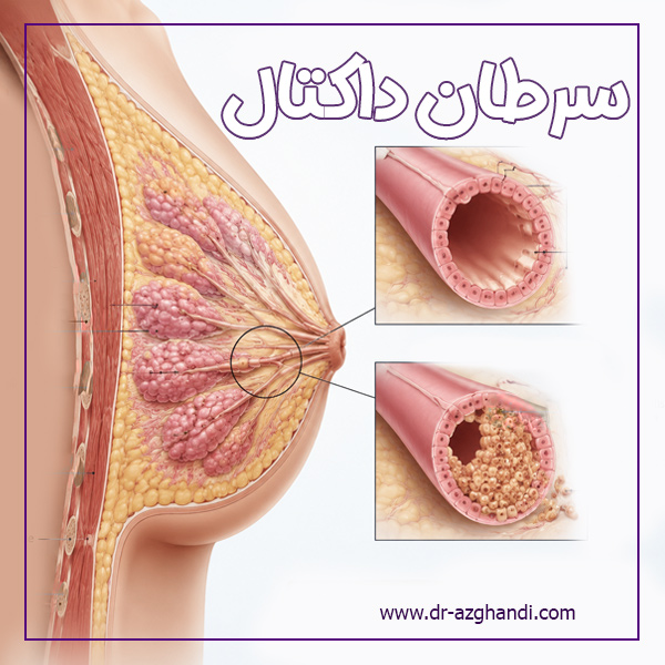 سرطان داکتال سینه چیست؟ علائم ، تشخیص و درمان کامل 1 ductal cancer 4 سرطان داکتال + دکتر سمیرا ازقندی
