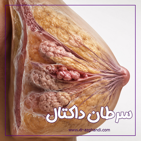 سرطان داکتال سینه چیست؟ علائم ، تشخیص و درمان کامل 3 ductal cancer 5 سرطان داکتال + دکتر سمیرا ازقندی