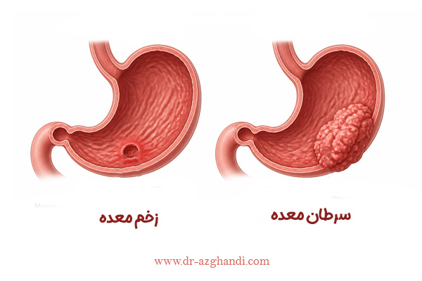 آیا زخم معده خطر ابتلا به سرطان را افزایش می دهد؟ 2 stomach ulcer and cancer 4 زخم معده و سرطان + دکتر سمیرا ازقندی