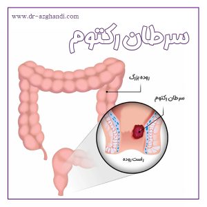 سرطان رکتوم + دکتر سمیرا ازقندی