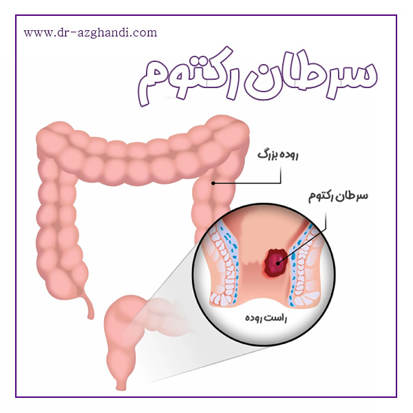 سرطان رکتوم + دکتر سمیرا ازقندی