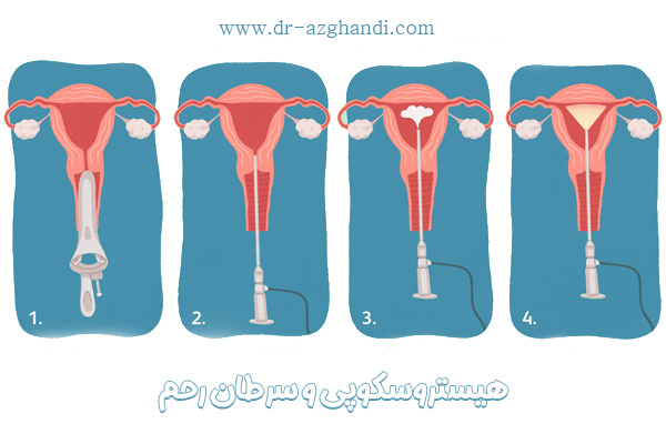 هیستروسکوپی و سرطان رحم | دکتر سمیرا ازقندی